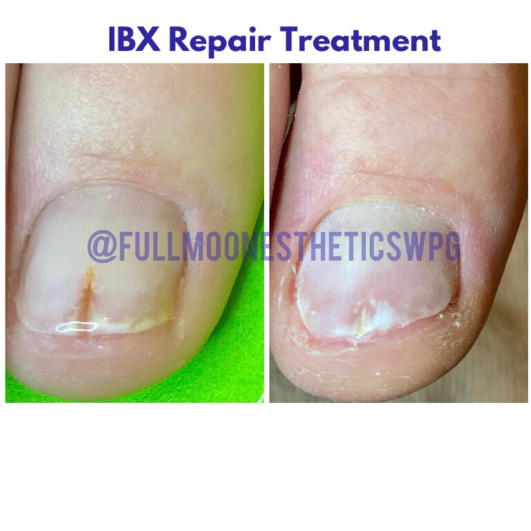 IBX-repair-treatment