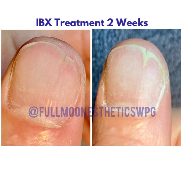 IBX-treatment_2-weeks