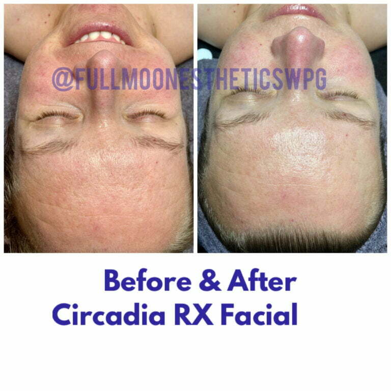 Before & after Circadia RX Facial